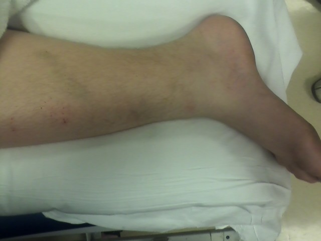 Isaac's Freakishly twisted ankle